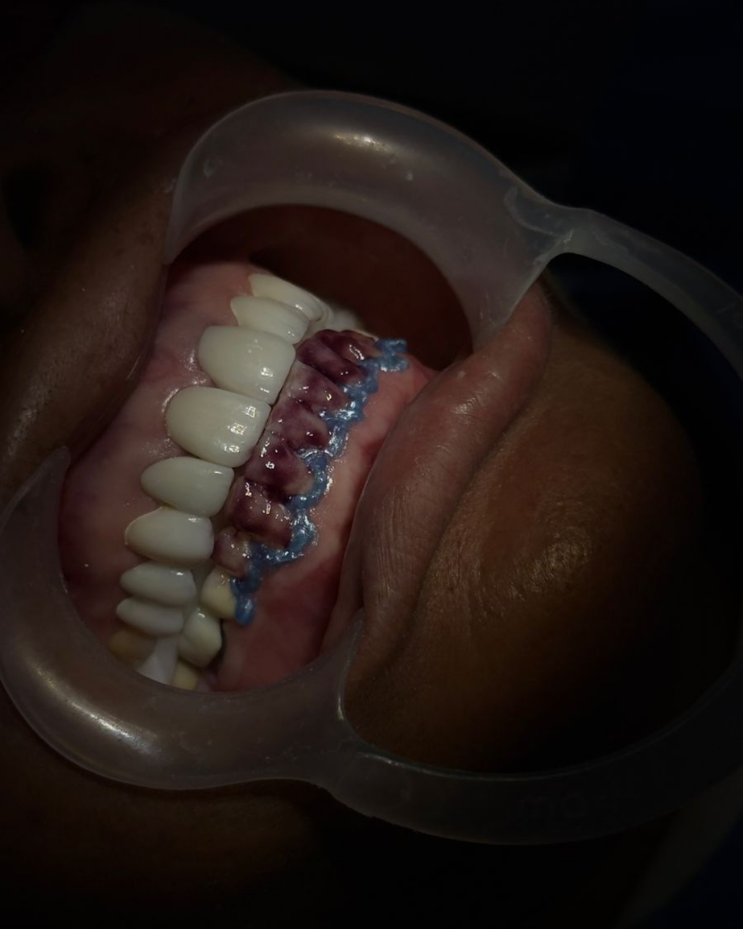 Blanqueamiento Dental